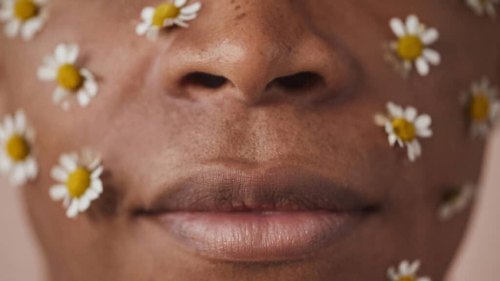 Cystic Acne Causes: Why Jawline and Cheek Breakouts Happen And What to Do