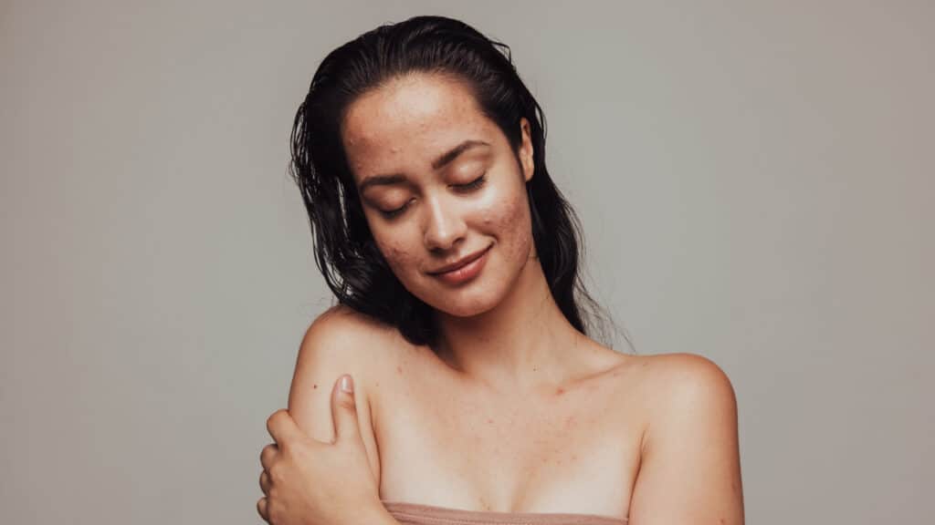 Adult Acne Explained. Everything you need to know.